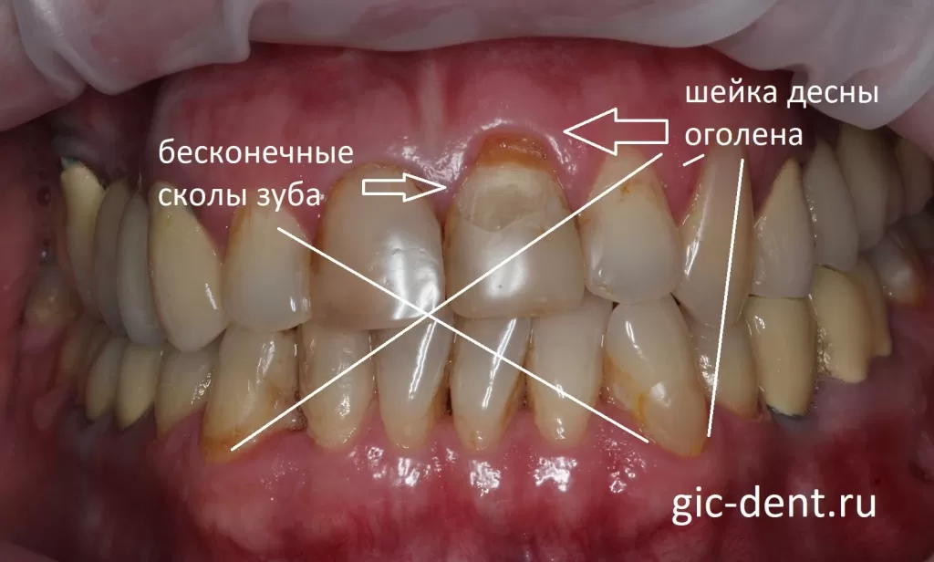 Бесконечные сколы зуба, оголение шеек сопровождают пациента до тех пор, пока причина не будет найдена
